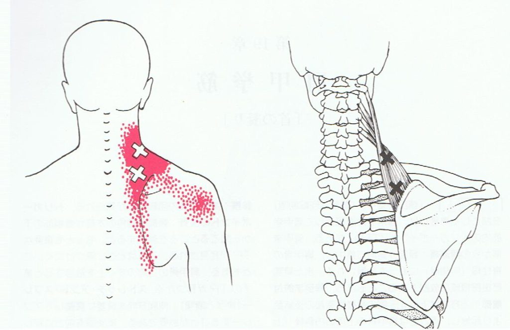 肩甲挙筋の筋膜痛