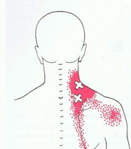 頚椎ヘルニア　筋膜疼痛症候群