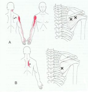 棘下筋　筋筋膜疼痛症候群