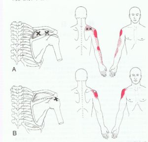 頚椎ヘルニア　腕の痛み　筋膜疼痛症候群