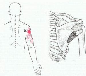 小円筋　筋筋膜疼痛症候群