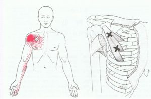 小胸筋　筋筋膜疼痛症候群
