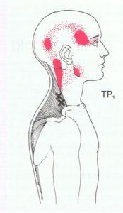 筋筋膜疼痛症候群の頭痛