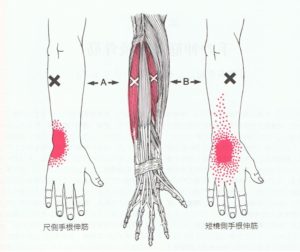 腱鞘炎に関係する筋肉