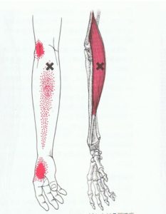腱鞘炎の原因になる筋肉