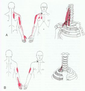 斜角筋症候群　筋筋膜疼痛症候群