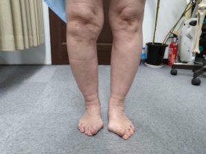 変形性膝関節症の婦人