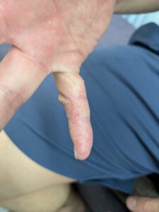 アトピー性皮膚炎